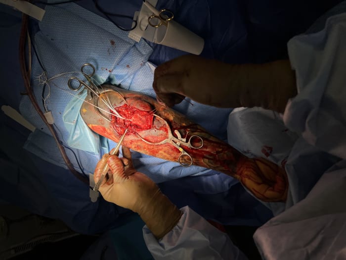 The triceps surgery (Courtesy of Josh Alexander)